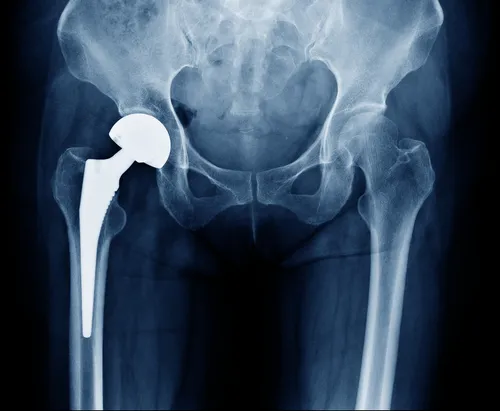 Report: Johnson & Johnson to Settle Metal Hip Implant Suits for $4 Billion - Hip Implant X-Ray